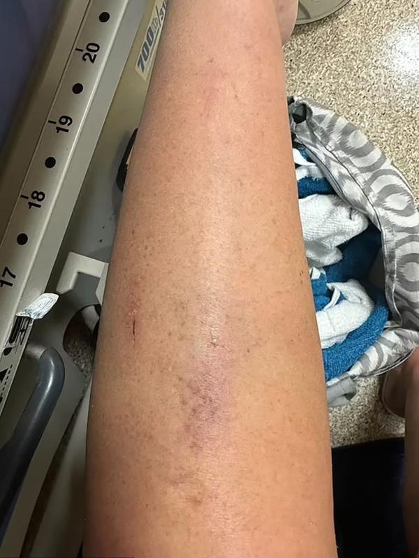 Shearer shared photos of the scratches and bruises she sustained during the assault.