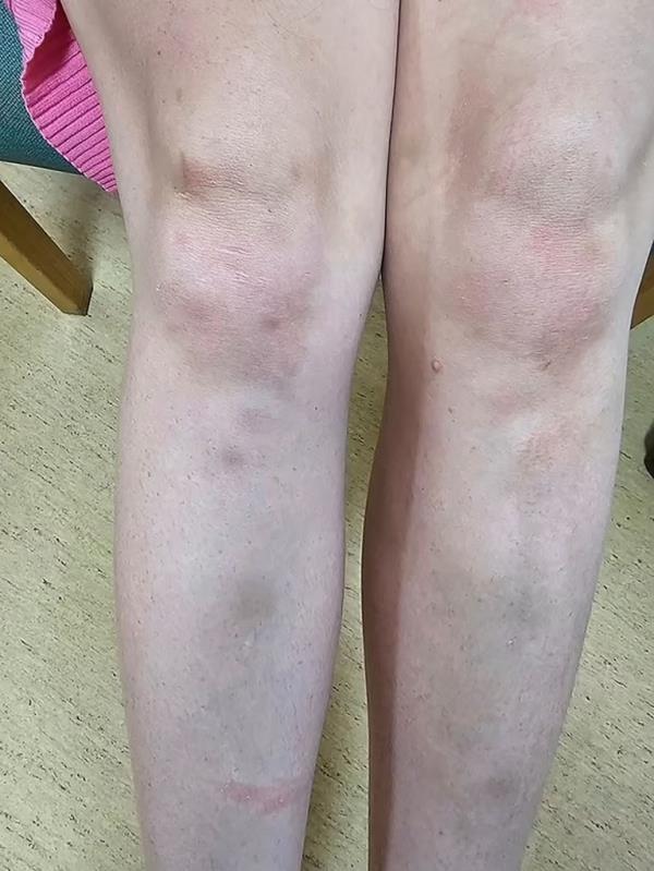 Dobson's legs were pictured, covered in bruises after the alleged assault on Feb. 4 while on vacation.