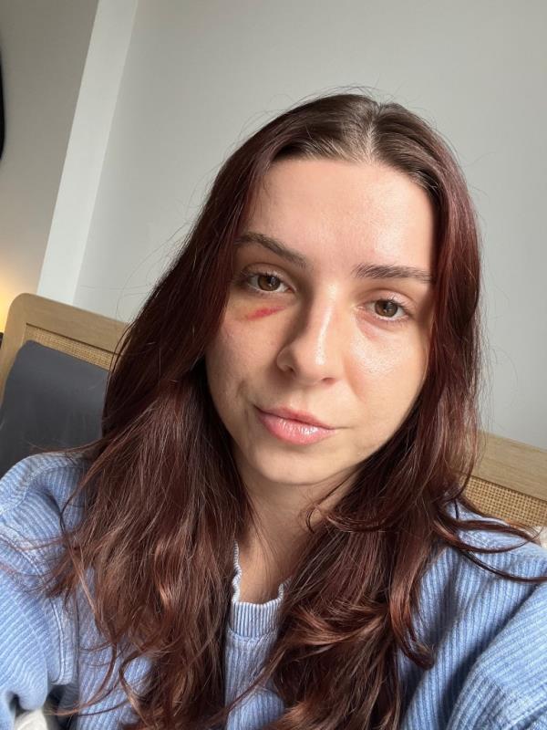 Mikayla To<em></em>ninato shows her bruised eye in a photo.