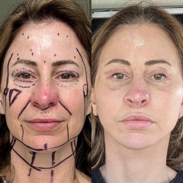 Kelly Beasley, 50, sold her house to get a facelift. 