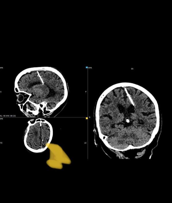 Doctors in Russia have discovered a needle embedded in the brain of an 80-year-old woman, who was likely the victim of a botched infanticide by her parents during World War II