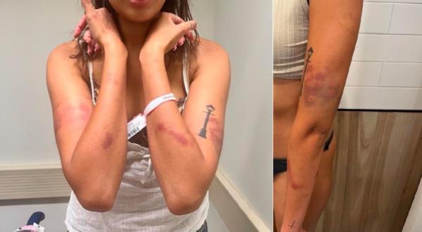 Bruises on Hubert-Ross' arms from the court docu<em></em>ments.
