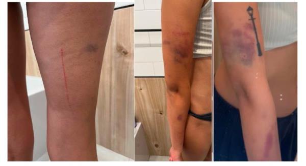 Bruises and scratches on Hubert-Ross' arms and legs.