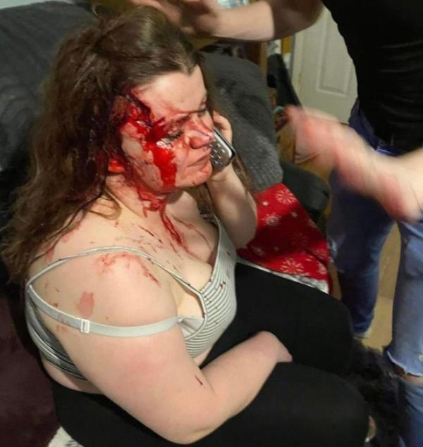 Pic by HotSpot Media -WOMAN REVEALS HORRIFIC INJURIES AFTER JEALOUS EX BASHED HER SKULL WITH A BRICK AFTER FOLLOWING HER HOME- HE WAS CAUGHT ON RING DOORBELL CAM, COVERED IN HER BLOOD- IN PIC - Shannon covered in her blood, on the phone to 999 after her ex partner bashed her head with a brick - A woman has released pictures of the horrific injuries she suffered when her jealous ex attacked her with a brick. Part of Shannon Johnson?s skull was left exposed after thug, Thomas Bardsley, 34, followed her home and launched a horrific assault on the mum-of-one. When Shannon, 25, fled inside her home, Bardsley can be seen on her ring cam doorbell footage, covered in her blood. In January this year, Bardsley was jailed for ten years, after being co<em></em>nvicted of wounding with intent and threats to kill. Now brave, Shannon, from Sussex, is sharing her story of survival to encourage other victims of abuse to speak out and report their attackers. SEE HOTSPOT MEDIA COPY 0121 551 1004...