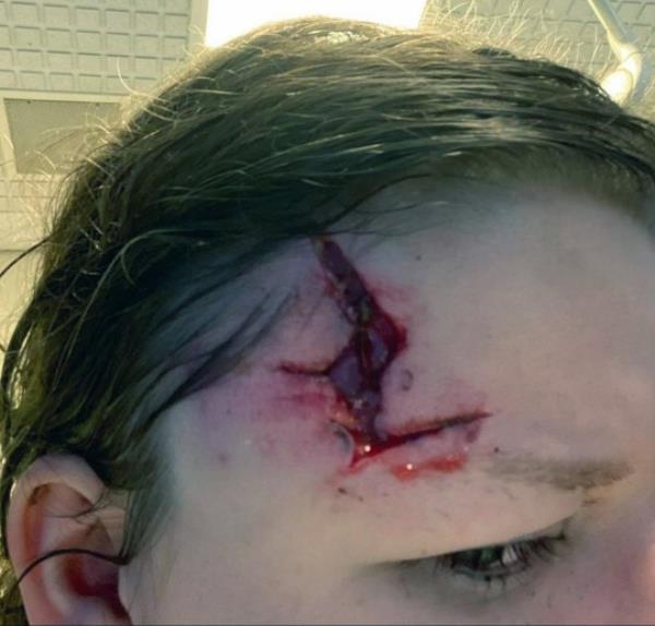 Pic by HotSpot Media -WOMAN REVEALS HORRIFIC INJURIES AFTER JEALOUS EX BASHED HER SKULL WITH A BRICK AFTER FOLLOWING HER HOME- HE WAS CAUGHT ON RING DOORBELL CAM, COVERED IN HER BLOOD- IN PIC - Shannon pictured in hospital with a huge gash in her head following the attack which left part of her skull exposed- A woman has released pictures of the horrific injuries she suffered when her jealous ex attacked her with a brick. Part of Shannon Johnson?s skull was left exposed after thug, Thomas Bardsley, 34, followed her home and launched a horrific assault on the mum-of-one. When Shannon, 25, fled inside her home, Bardsley can be seen on her ring cam doorbell footage, covered in her blood. In January this year, Bardsley was jailed for ten years, after being co<em></em>nvicted of wounding with intent and threats to kill. Now brave, Shannon, from Sussex, is sharing her story of survival to encourage other victims of abuse to speak out and report their attackers. SEE HOTSPOT MEDIA COPY 0121 551 1004...
