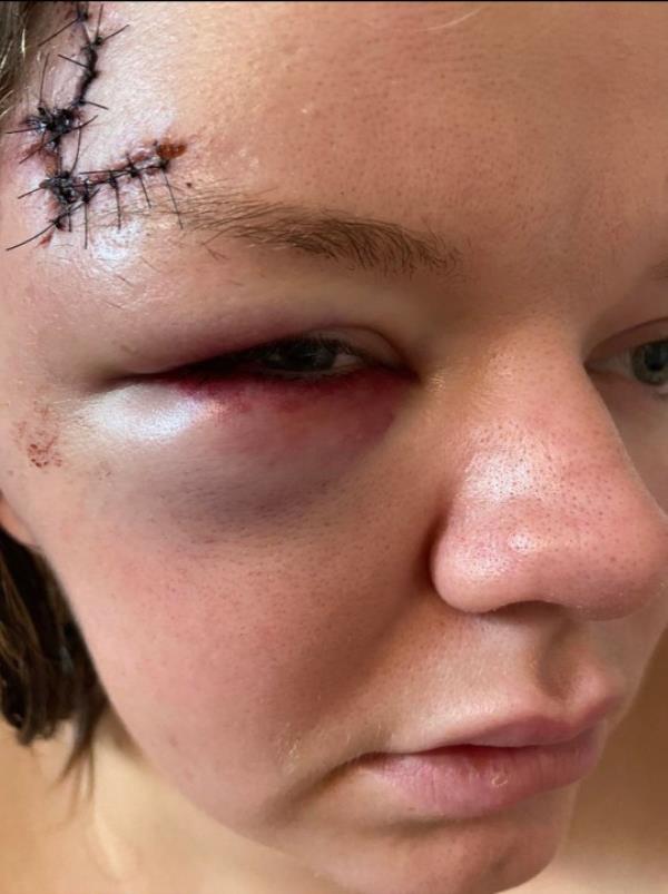 Pic by HotSpot Media -WOMAN REVEALS HORRIFIC INJURIES AFTER JEALOUS EX BASHED HER SKULL WITH A BRICK AFTER FOLLOWING HER HOME- HE WAS CAUGHT ON RING DOORBELL CAM, COVERED IN HER BLOOD- IN PIC - Shannon pictured with a horrific black eye and head wound following the attack - A woman has released pictures of the horrific injuries she suffered when her jealous ex attacked her with a brick. Part of Shannon Johnson?s skull was left exposed after thug, Thomas Bardsley, 34, followed her home and launched a horrific assault on the mum-of-one. When Shannon, 25, fled inside her home, Bardsley can be seen on her ring cam doorbell footage, covered in her blood. In January this year, Bardsley was jailed for ten years, after being co<em></em>nvicted of wounding with intent and threats to kill. Now brave, Shannon, from Sussex, is sharing her story of survival to encourage other victims of abuse to speak out and report their attackers. SEE HOTSPOT MEDIA COPY 0121 551 1004...