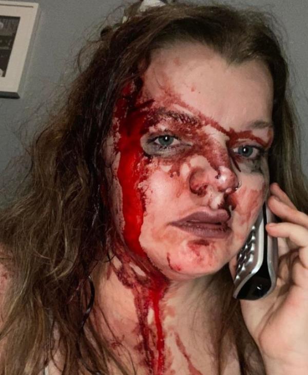 Pic by HotSpot Media -WOMAN REVEALS HORRIFIC INJURIES AFTER JEALOUS EX BASHED HER SKULL WITH A BRICK AFTER FOLLOWING HER HOME- HE WAS CAUGHT ON RING DOORBELL CAM, COVERED IN HER BLOOD- IN PIC - Shannon covered in her blood, on the phone to 999 after her ex partner bashed her head with a brick- A woman has released pictures of the horrific injuries she suffered when her jealous ex attacked her with a brick. Part of Shannon Johnson?s skull was left exposed after thug, Thomas Bardsley, 34, followed her home and launched a horrific assault on the mum-of-one. When Shannon, 25, fled inside her home, Bardsley can be seen on her ring cam doorbell footage, covered in her blood. In January this year, Bardsley was jailed for ten years, after being co<em></em>nvicted of wounding with intent and threats to kill. Now brave, Shannon, from Sussex, is sharing her story of survival to encourage other victims of abuse to speak out and report their attackers. SEE HOTSPOT MEDIA COPY 0121 551 1004...
