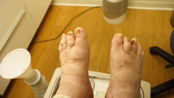 medical pedicure